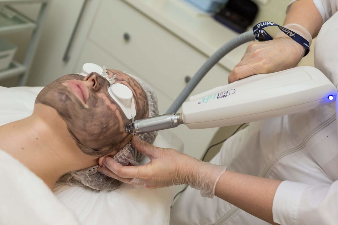 Las sesiones de láser exfolian el rostro