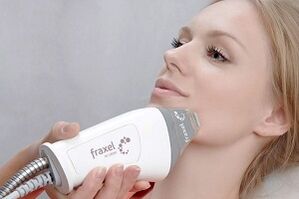 La esencia de los procedimientos fraccionados de rejuvenecimiento de la piel del rostro.