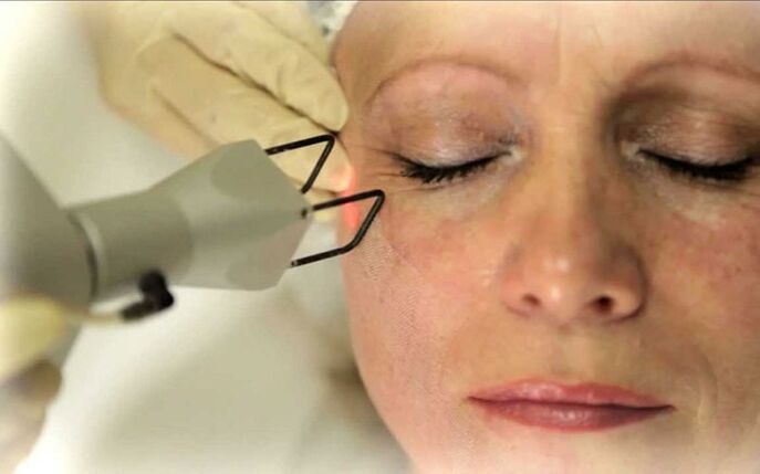 El láser elimina las arrugas alrededor de los ojos.